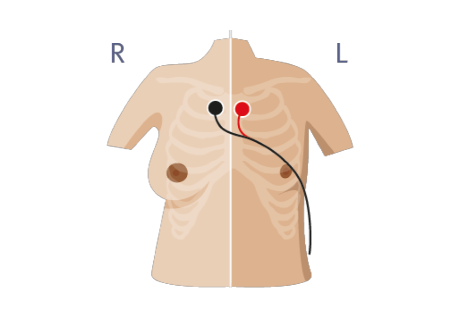 ecg-stap-1