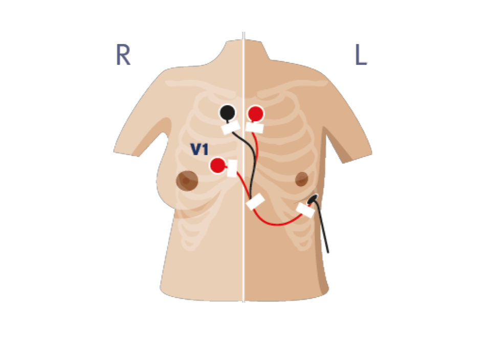 ecg-stap-2