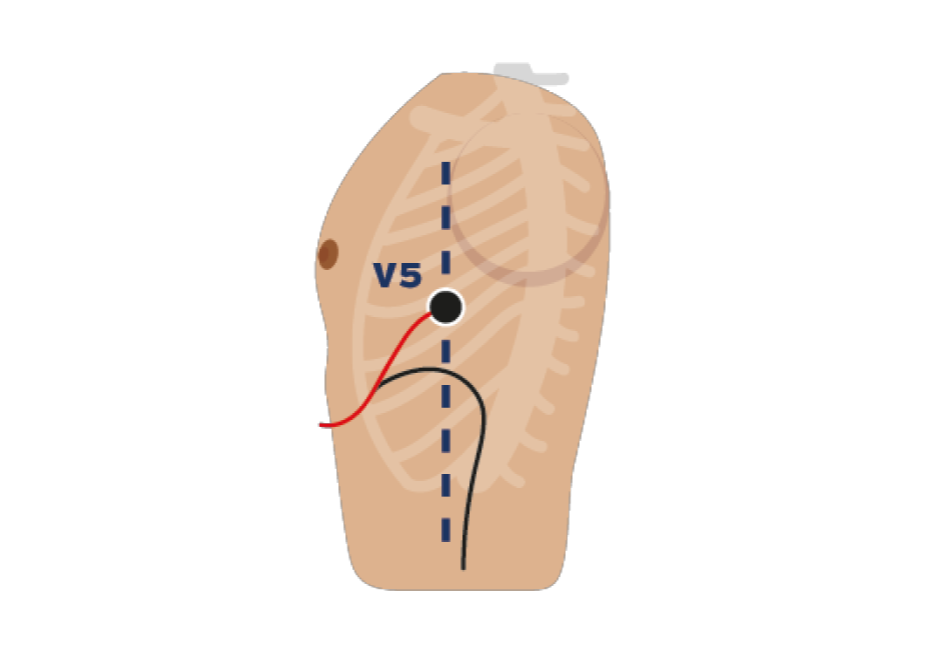 ecg-stap-3